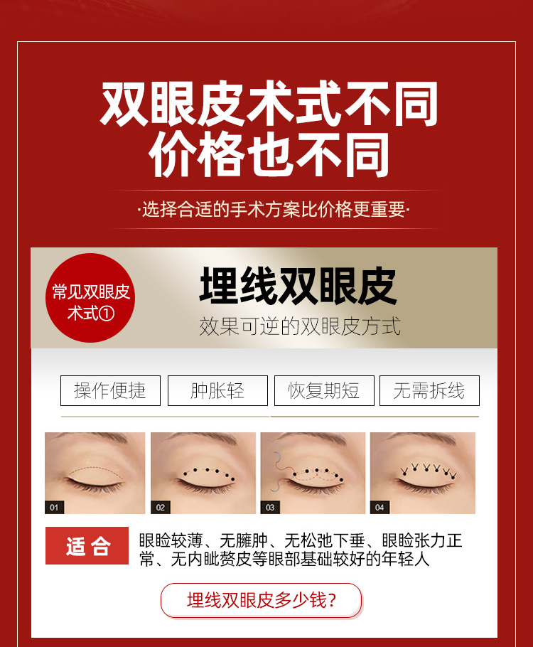 埋线双眼皮适应人群