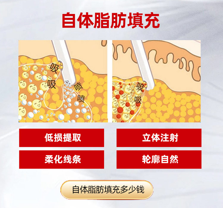 华美自体脂肪丰额头