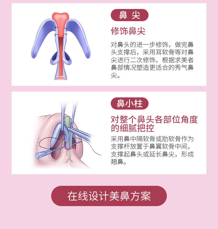桃花鼻手术方案