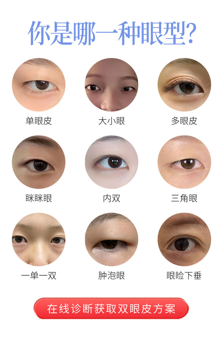 割双眼皮适应症