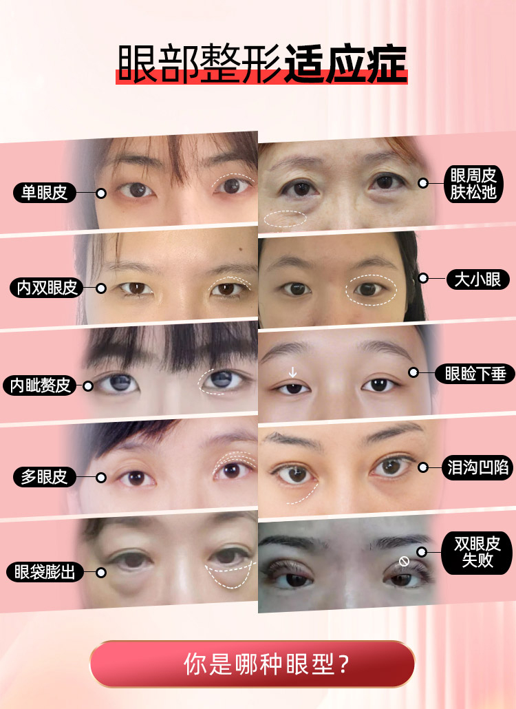 眼部整形适应人群