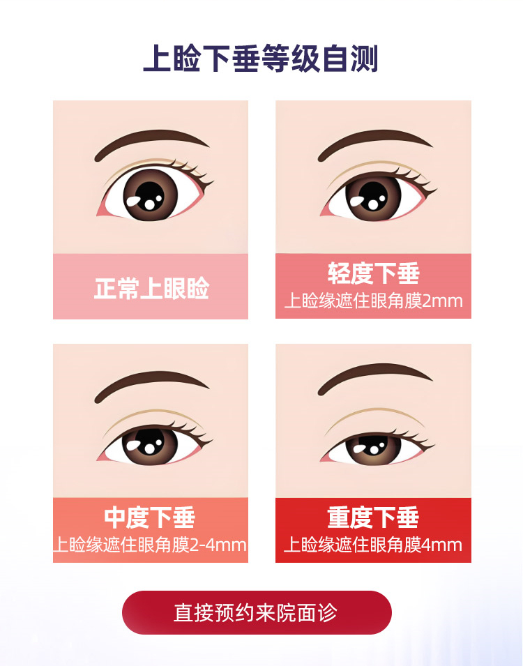 上睑下垂程度自测