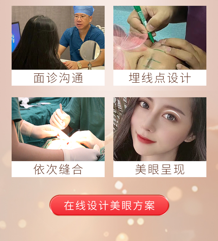 埋线双眼皮手术流程