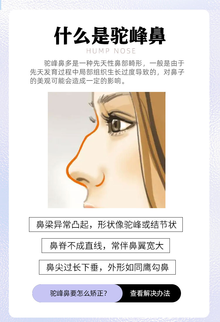 什么是驼峰鼻