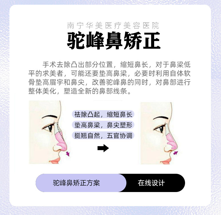 驼峰鼻怎么矫正
