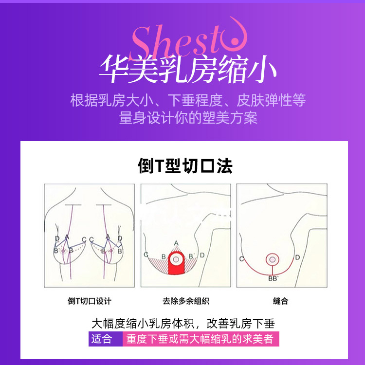 乳房缩小手术方法