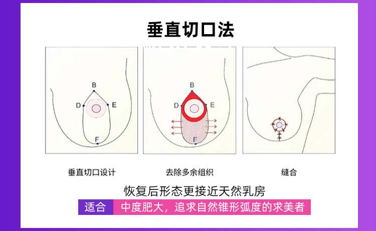 乳房缩小手术方法