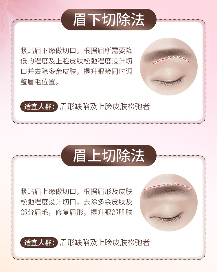 华美切眉方法选择