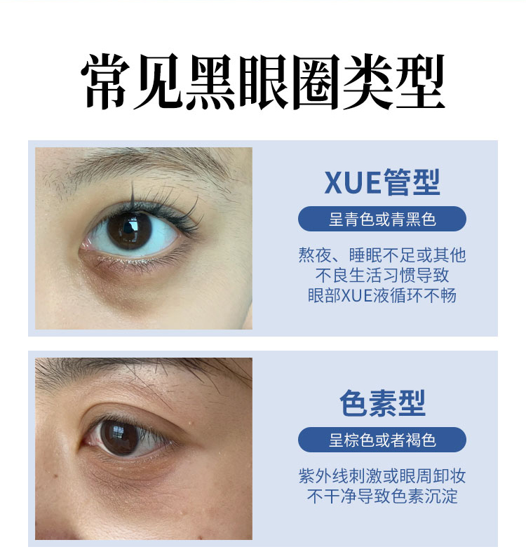 黑眼圈分类