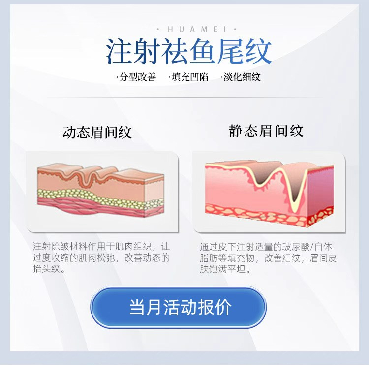 注射祛鱼尾纹怎么样