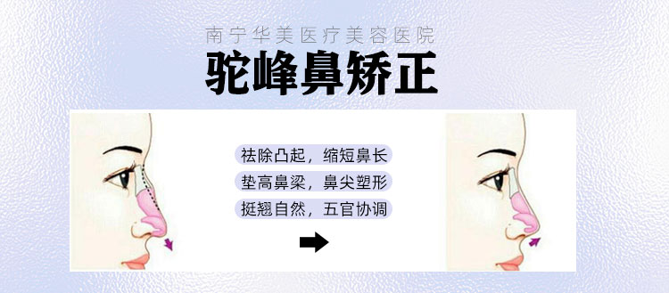 华美驼峰鼻矫正,广西驼峰鼻矫正医院
