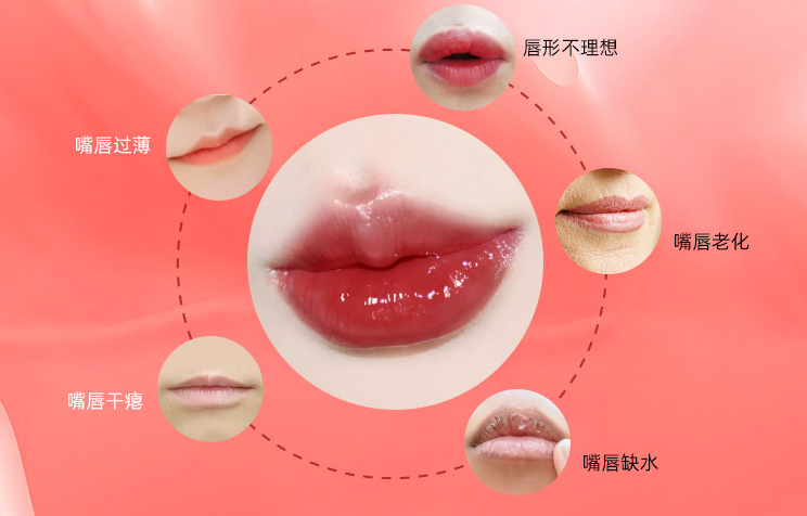 南宁注射丰唇怎么样,南宁丰唇医院哪家好,南宁丰唇材料,南宁口周年轻化,广西专业整形医院